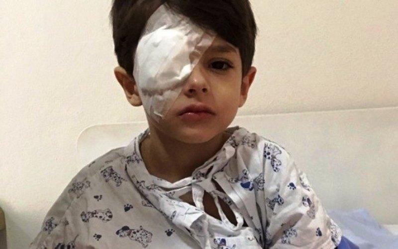 Menino de 5 anos tem córnea queimada por álcool em gel