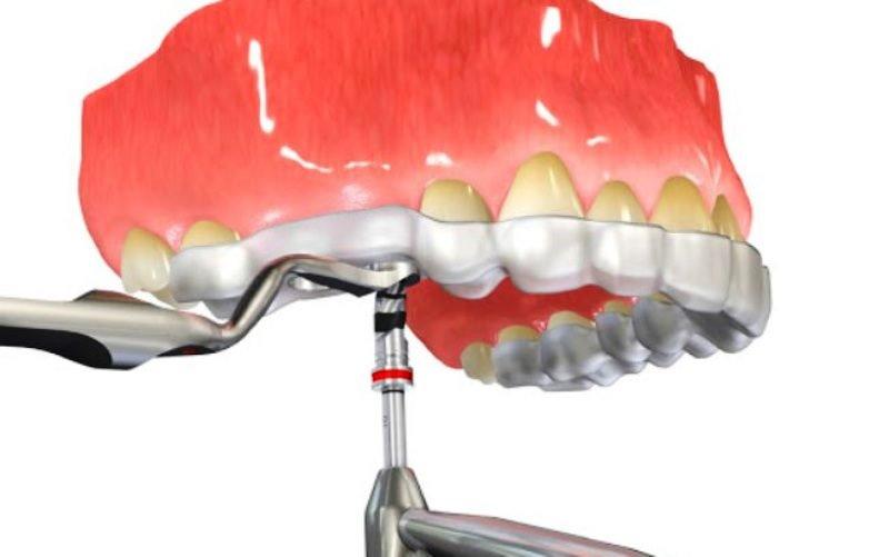 Implantes sem cortes? entenda como é a cirurgia guiada, na odontologia