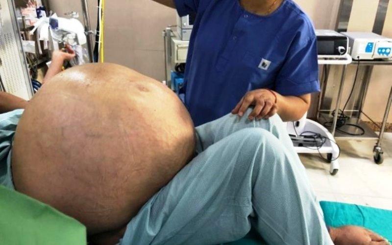 Tumor ovariano de 50 kg é removido de mulher em cirurgia