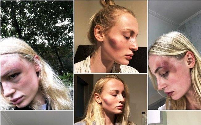 Modelo expõe ferimentos após ser agredida por ex-namorado: 