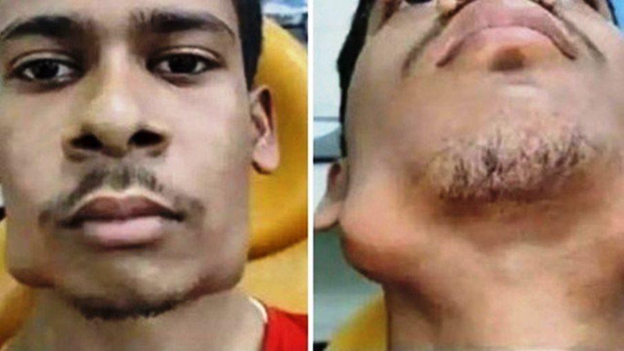 Jovem de 17 anos passa por cirurgia para retirar 82 dentes extras