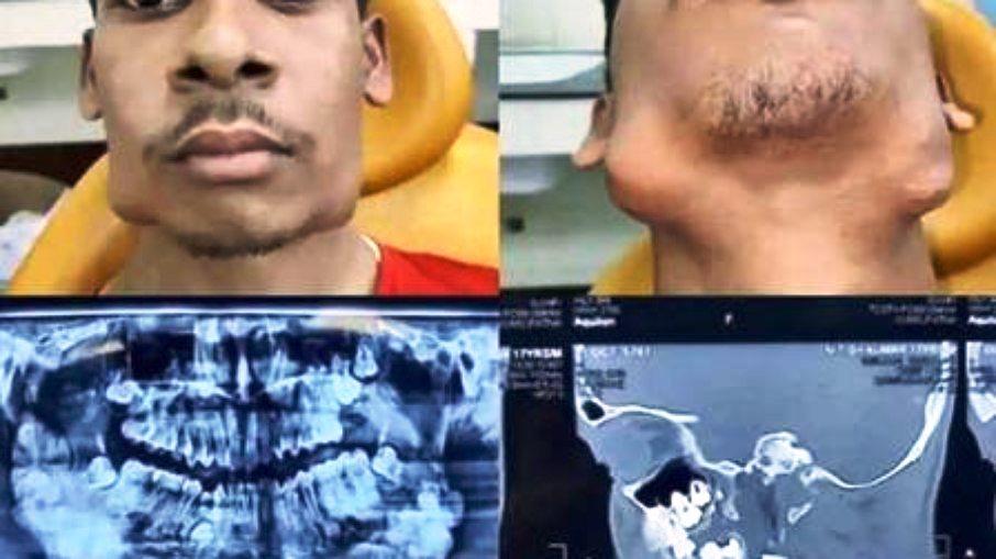 Jovem de 17 anos passa por cirurgia para retirar 82 dentes extras