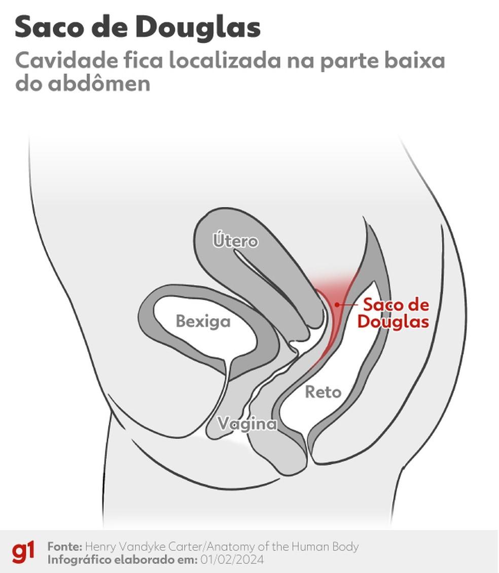 Saco de Douglas: entenda o que é a região citada no atestado de óbito de jovem que teve encontro com jogador