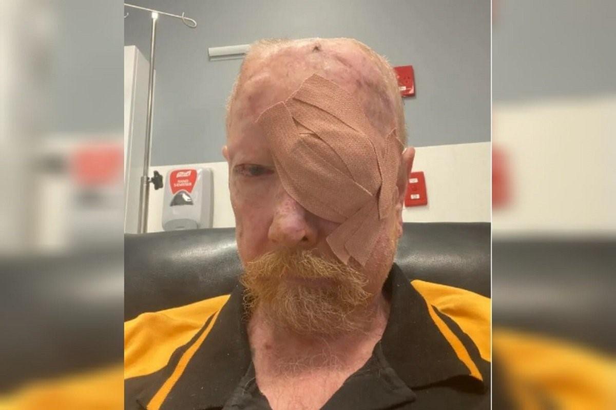 Câncer de pele: homem retira 200 tumores e fica com face desfigurada