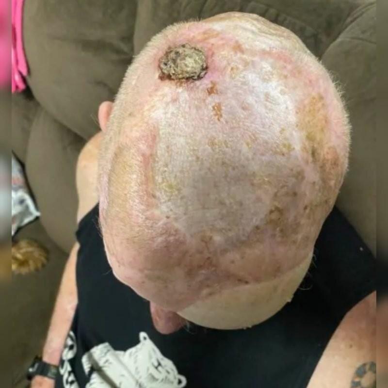 Câncer de pele: homem retira 200 tumores e fica com face desfigurada