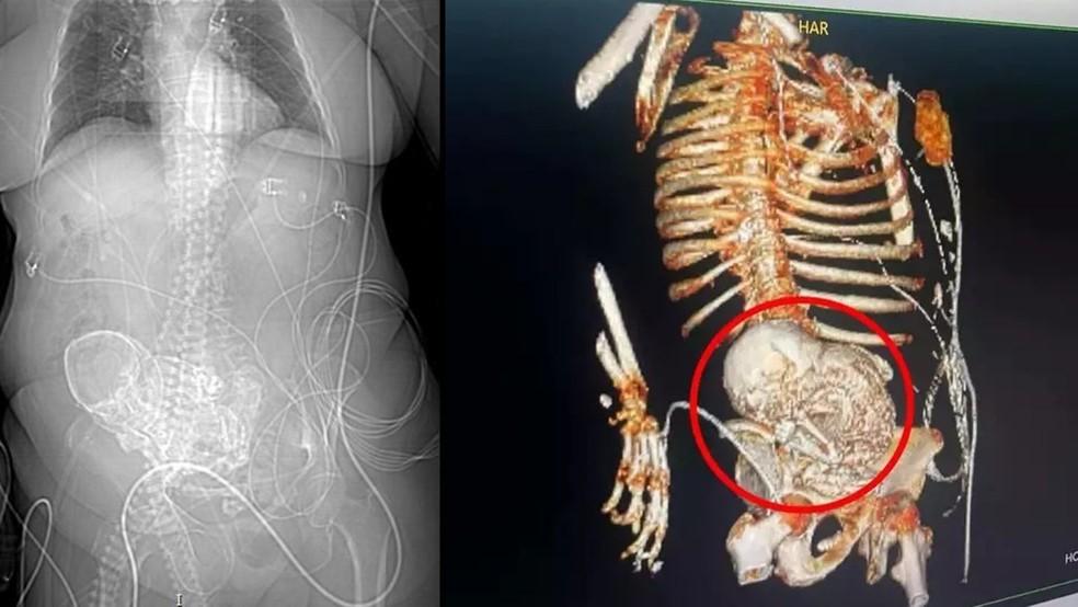 ‘Bebê de pedra’: idosa descobre feto calcificado que carregou por 56 anos e morre após cirurgia de retirada