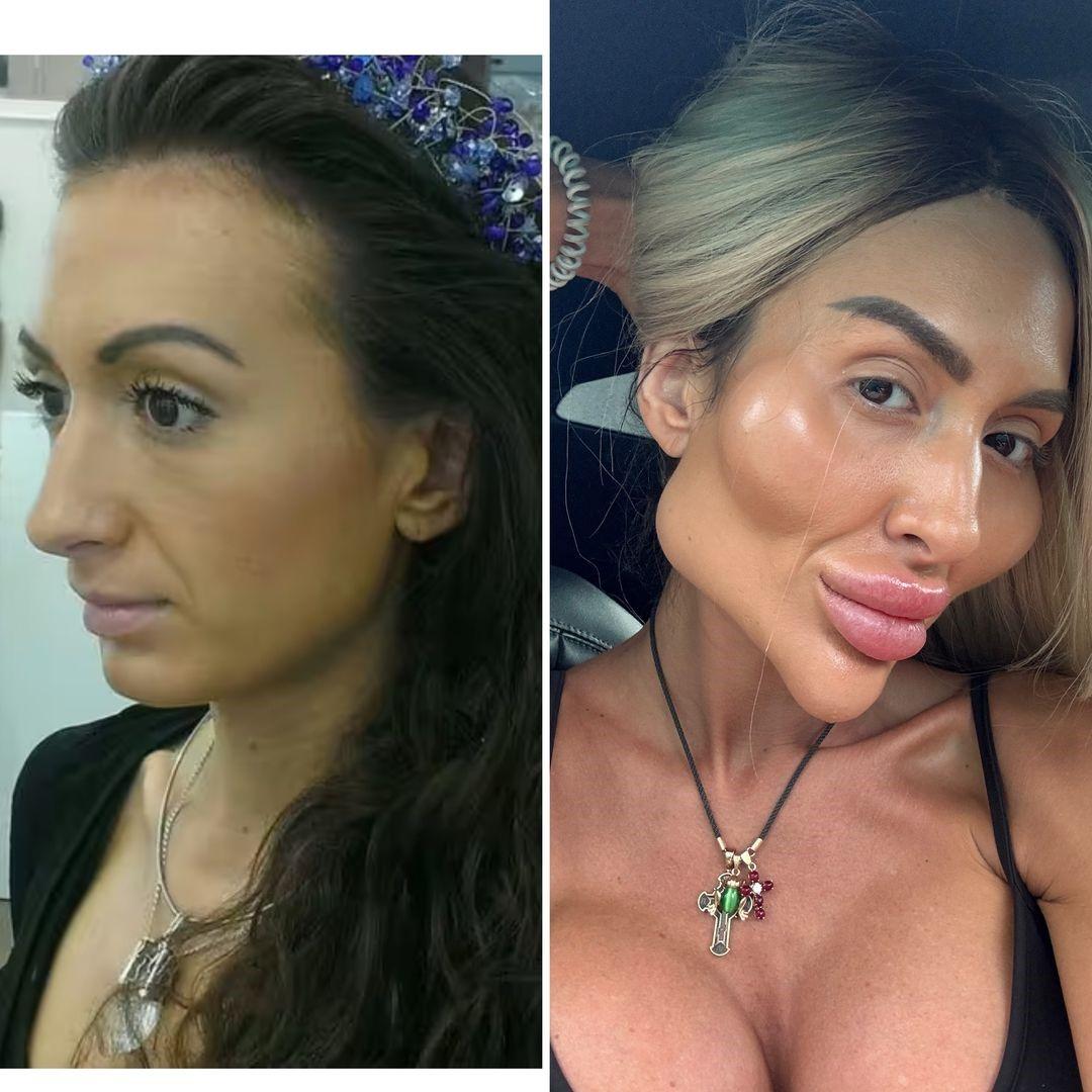 Dona das maiores bochechas do mundo mostra face antes de procedimentos