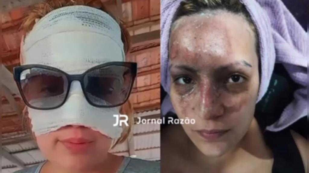 Leite quente ‘explode’ no micro-ondas e mulher tem 70% do rosto queimado