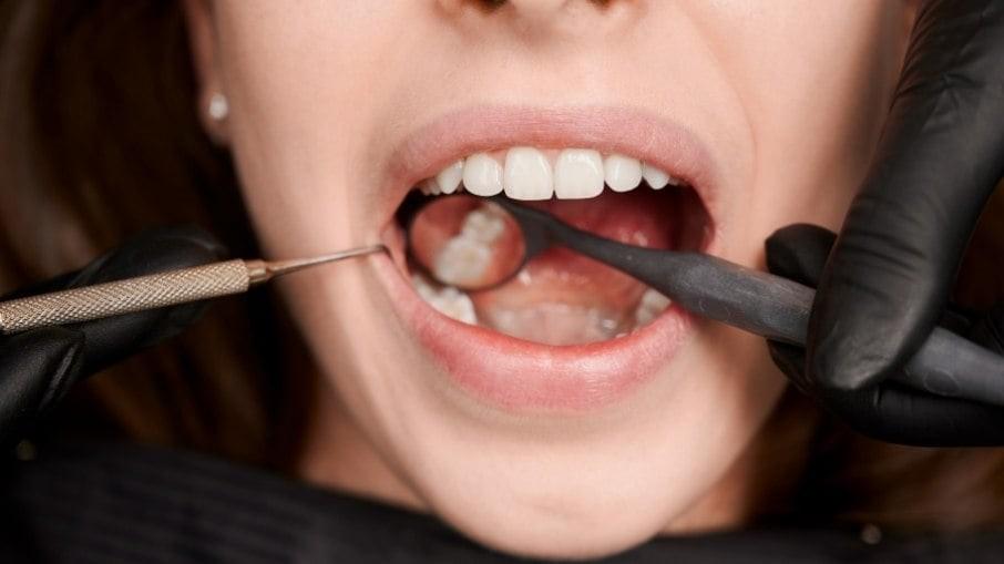 Vai tirar o dente do siso? Confira os principais cuidados