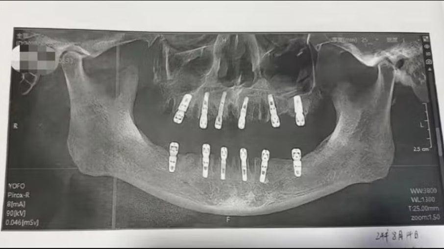 Homem morre após cirurgia para extrair 23 dentes e implantar outros 12 no mesmo dia