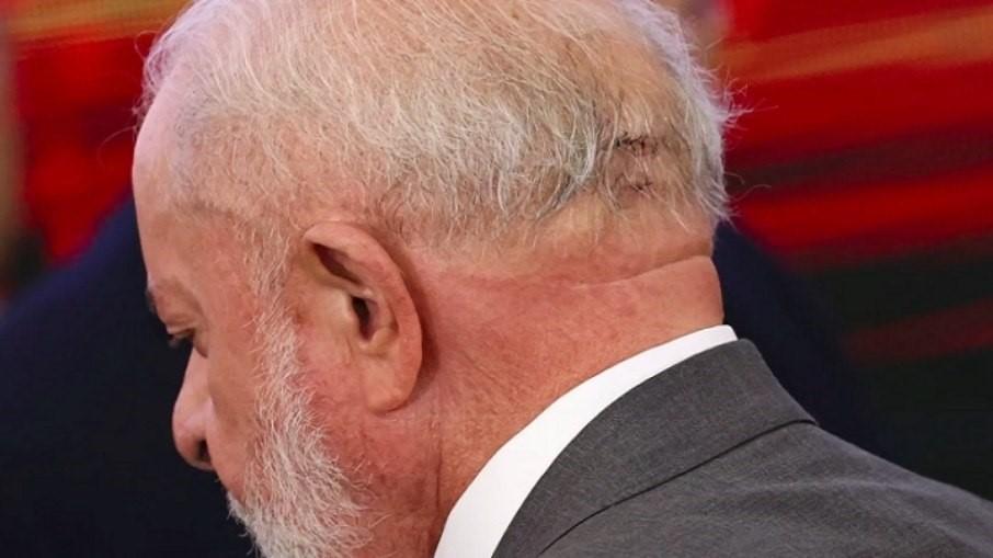 Lula passa por cirurgia de emergência e está internado em UTI de hospital em São Paulo