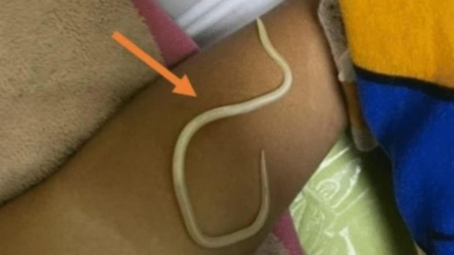 Criança vomita vermes depois de semanas com dores e diagnóstico errado de infecção e gases