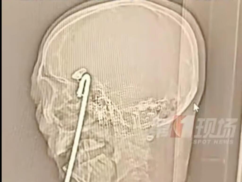 Chinês embriagado se empala em barra de metal e sobrevive após cirurgia de 10 horas