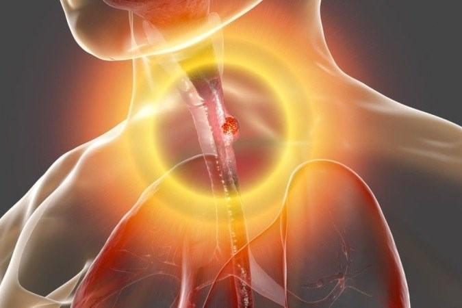 Conheça os riscos e as causas do refluxo gastroesofágico