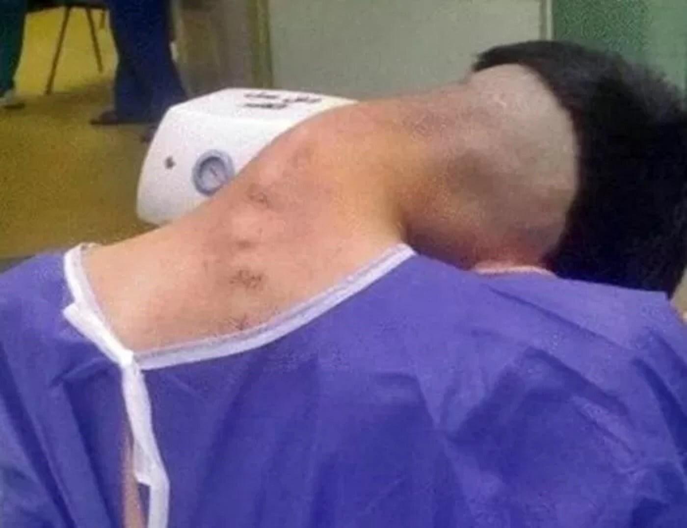 Irã registra caso raro de síndrome da cabeça caída por uso de drogas