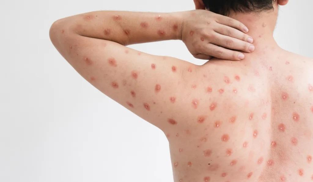 Sesa confirma caso de Mpox ou “varíola dos macacos”, em Linhares, no ES