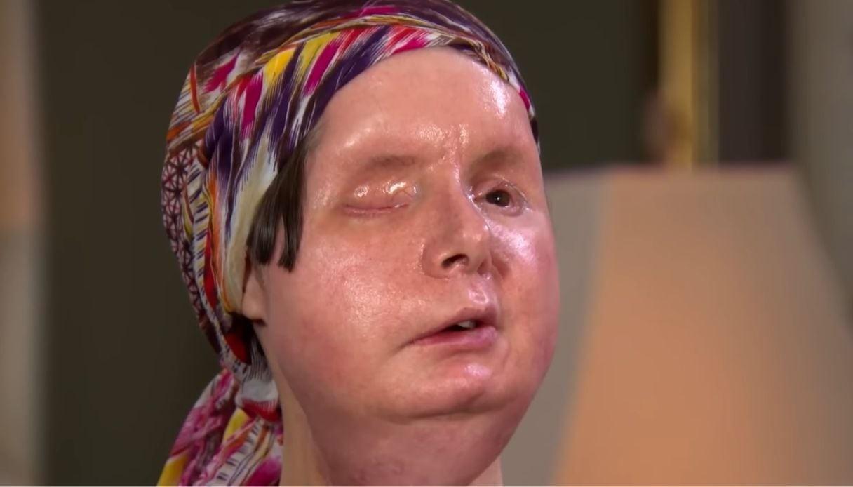Mulher desfigurada por chimpanzé mostra rosto 16 anos após transplante pioneiro de face