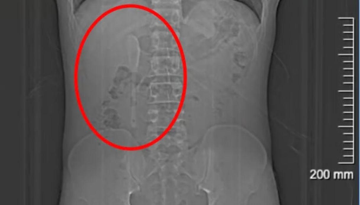 Cirurgia retira colher do intestino de homem que achava ter sonhado engolir objeto