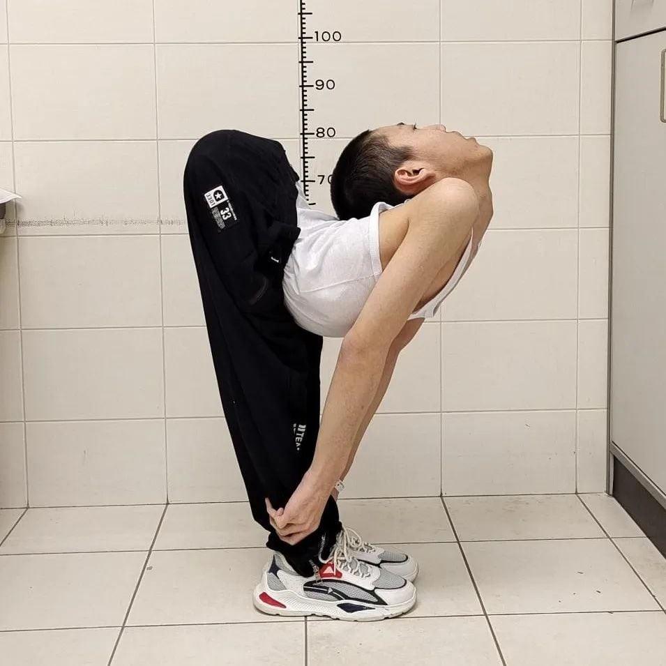 ‘Menino dobrado’ passa por cirurgias e endireita a coluna pela primeira vez