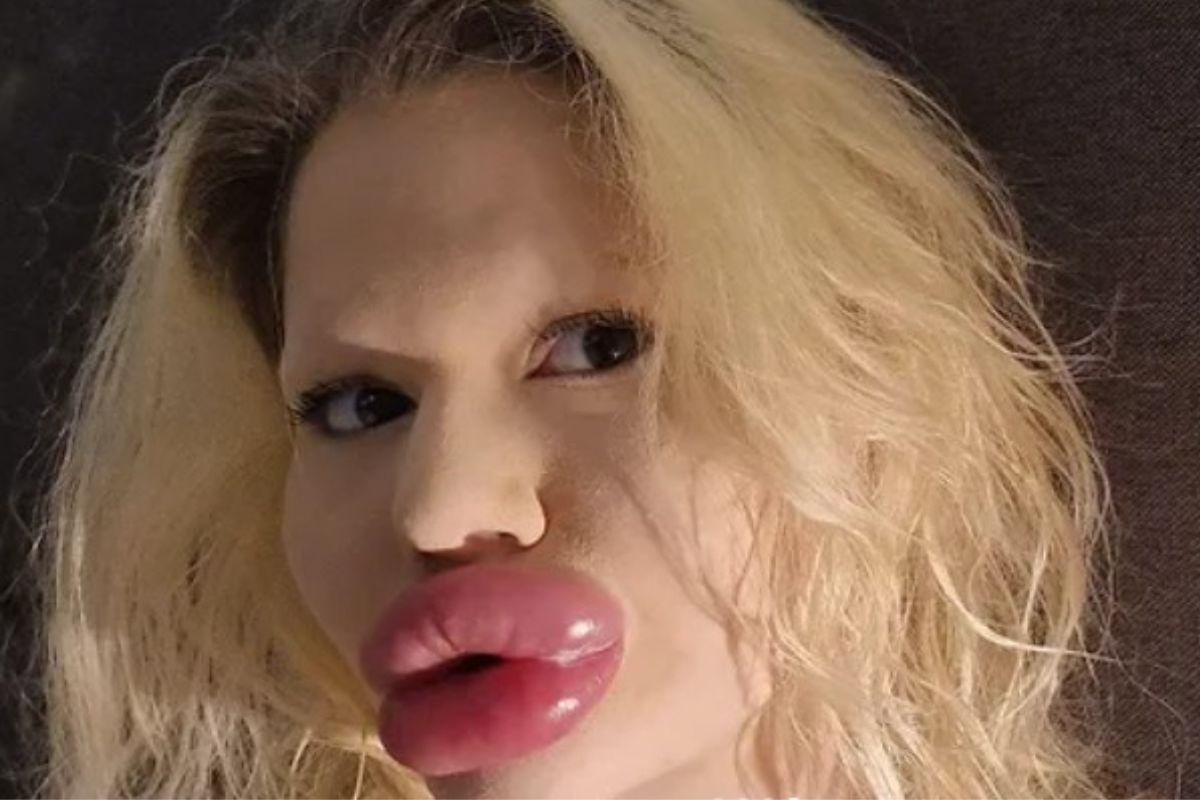 Dentistas se recusam a atender “mulher com maiores lábios do mundo”