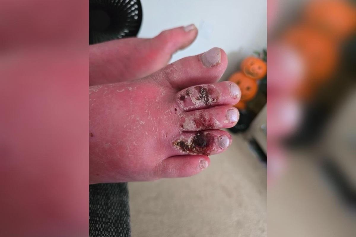 Após dar à luz, mãe é diagnosticada com doença que “incendeia” a pele