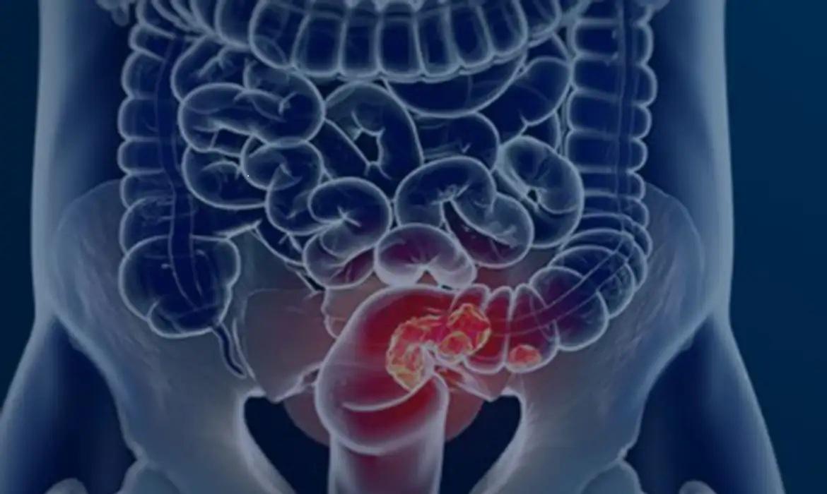 Pacientes com câncer colorretal são diagnosticados em estágio avançado