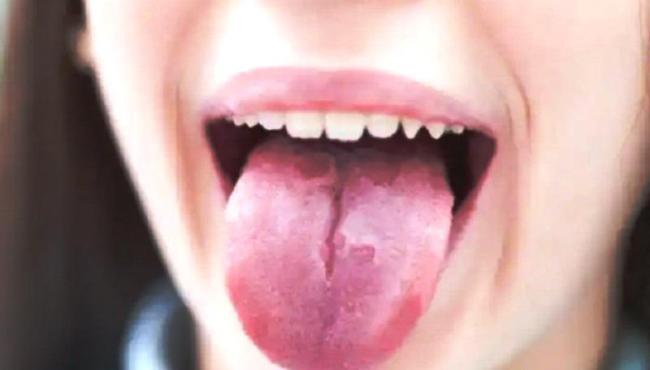 3 doenças infantis mais comuns que causam alterações na língua; fique atento aos sinais