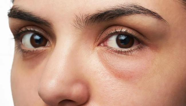 Adeus, olheiras: Soluções simples e eficazes para despertar com o olhar renovado