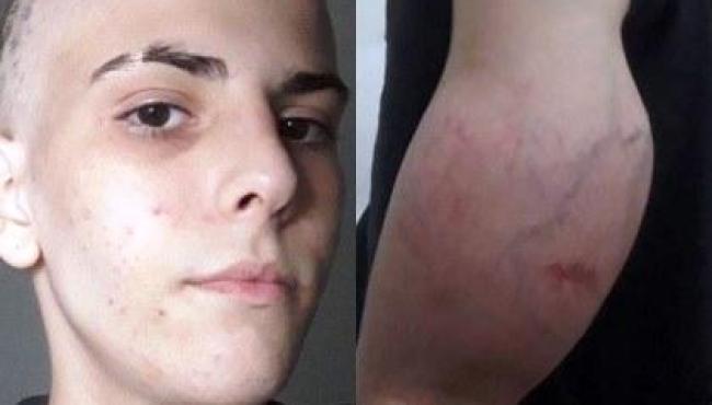 Adolescente descobre câncer e terá que amputar braço deformado