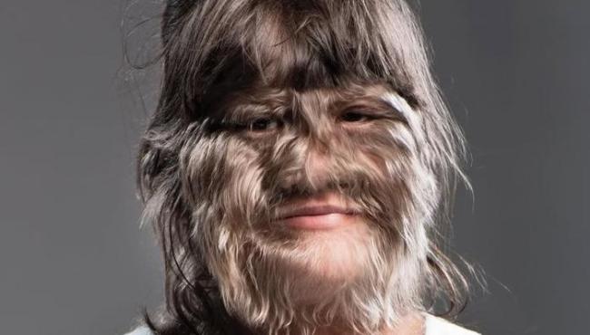“Adolescente mais peluda do mundo” aparece irreconhecível aos 25 anos