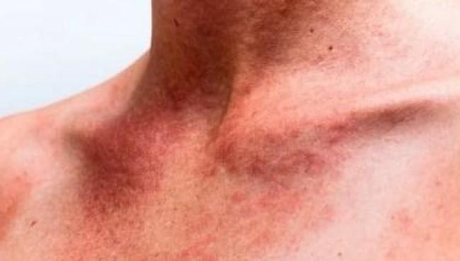 Alergia ao Sol: entenda a doença que atinge 10% da população