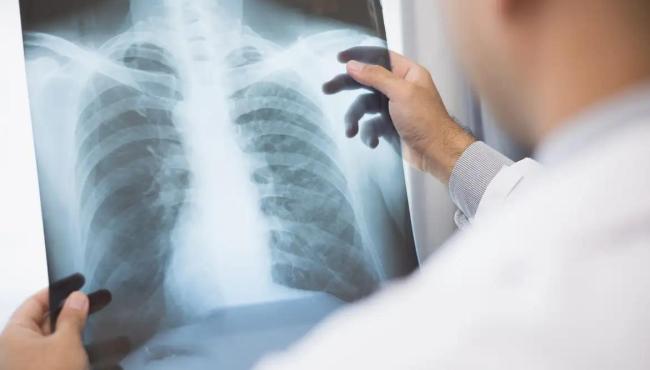 Anvisa aprova novo medicamento para câncer de pulmão avançado