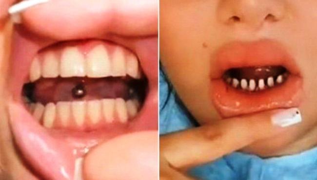 ‘Assassinato de dentes’ por ‘sorriso perfeito’, diz dentista