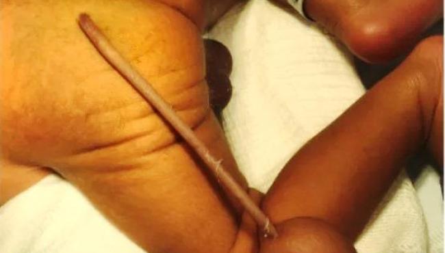 Bebê brasileiro nasce com cauda de 12 cm e bola de 4 cm na extremidade