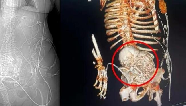 ‘Bebê de pedra’: idosa descobre feto calcificado que carregou por 56 anos e morre após cirurgia de retirada