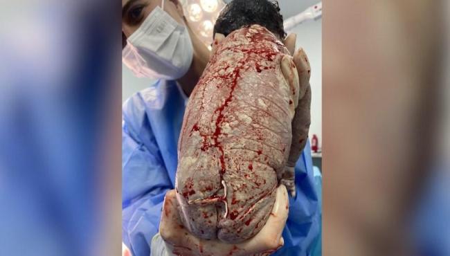 Bebê nasce com DIU preso ao corpo e imagem viraliza na web