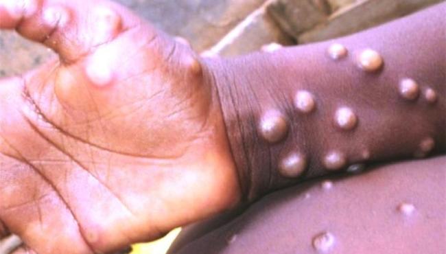 Brasil já tem oito casos confirmados de varíola dos macacos: Veja dicas de como se prevenir da doença