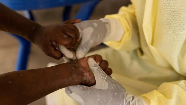 Brasil registra 88 casos de Mpox em 2026; saiba como evitar a doença