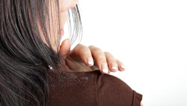 Caspa aumenta no frio? Dermatologista explica como tratar condição