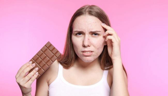 Chocolate causa acne? Saiba a verdade por trás dessa dúvida