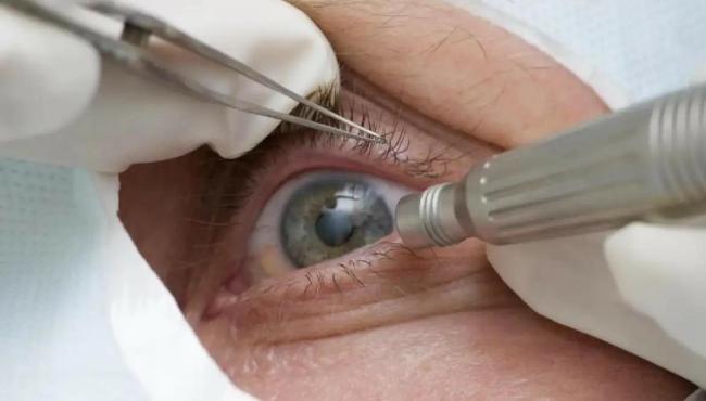 Cirurgia que altera cor do olho tem uso restrito para pessoas cegas