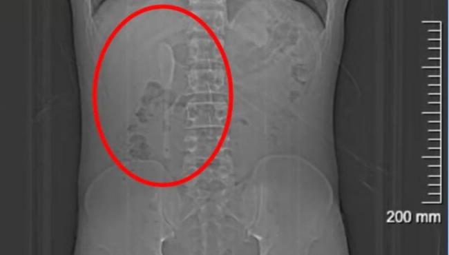 Cirurgia retira colher do intestino de homem que achava ter sonhado engolir objeto