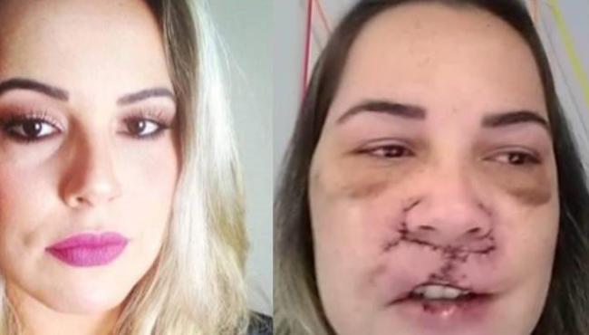 “Corroeu as células”, revela influenciadora que teve rosto deformado