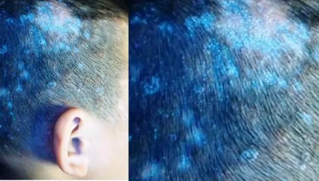 Criança fica com couro cabeludo brilhante após infecção fúngica
