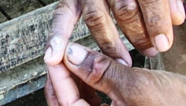 ES investiga quatro casos suspeitos de varíola bovina em humanos