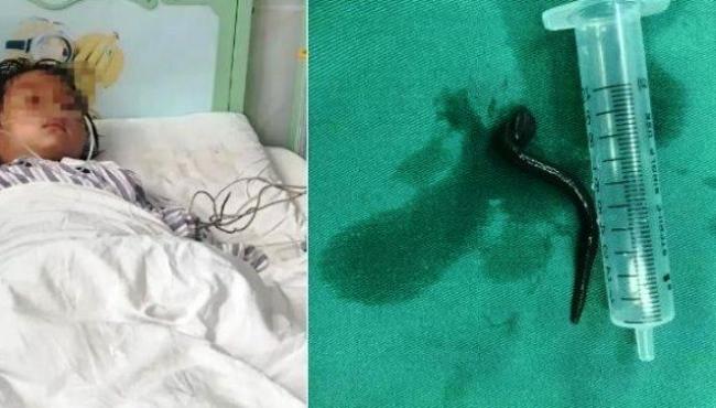 Garotinha com tosse e falta de ar tem sanguessuga removida da garganta