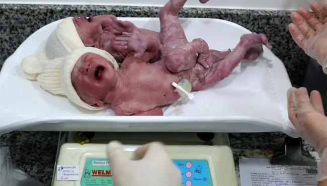 Gêmeos siameses nascem unidos pelo sacro; médica revela que caso é ainda mais raro