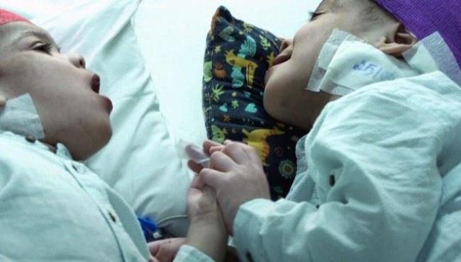 Gêmeos unidos pelo crânio são separados após nove cirurgias; equipe médica brasileira se torna referência