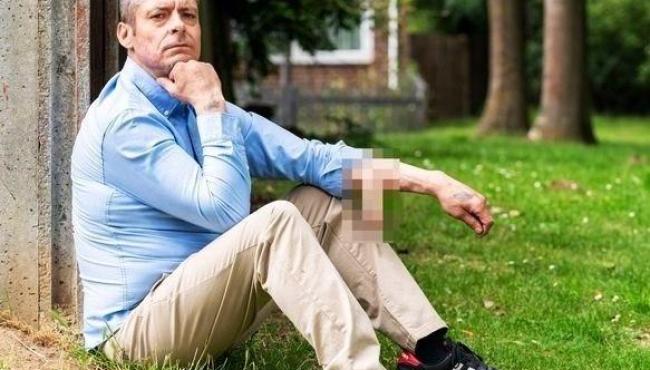 Homem celebra cirurgia peniana após ter órgão colocado no braço por 6 anos