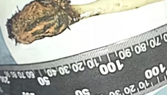 Homem descobre que tinha uma escova de dentes presa no intestino há 52 anos